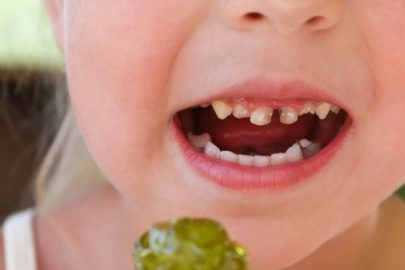 Okul Çağı Çocuklarda Diş Sağlığı ve Beslenme: Çürüğe Karşı Akıllı Seçimler